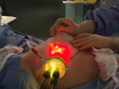 Policlinico: primo intervento combinato chirurgia oncologica senologica-chirurgia plastica ricostruttiva con approccio mini-invasivo endoscopico